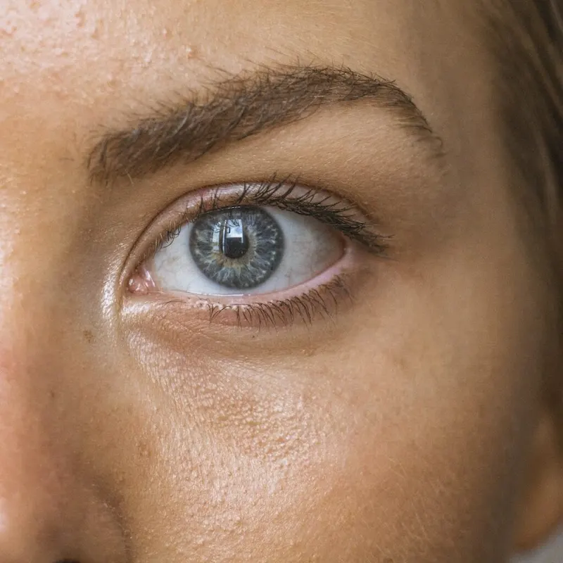 Hyperpigmentation, Sun Spot Treatment in NYC