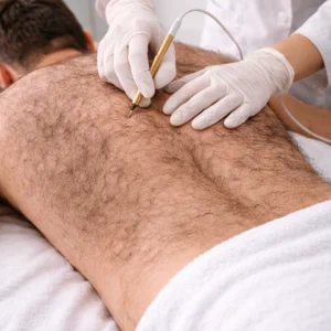 Electrolysis on Back