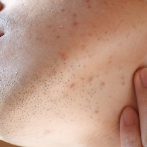 Electrolysis Scarring